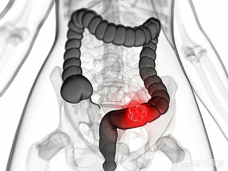 今日特码科普！腹泻几天确诊结肠癌,百科词条爱好